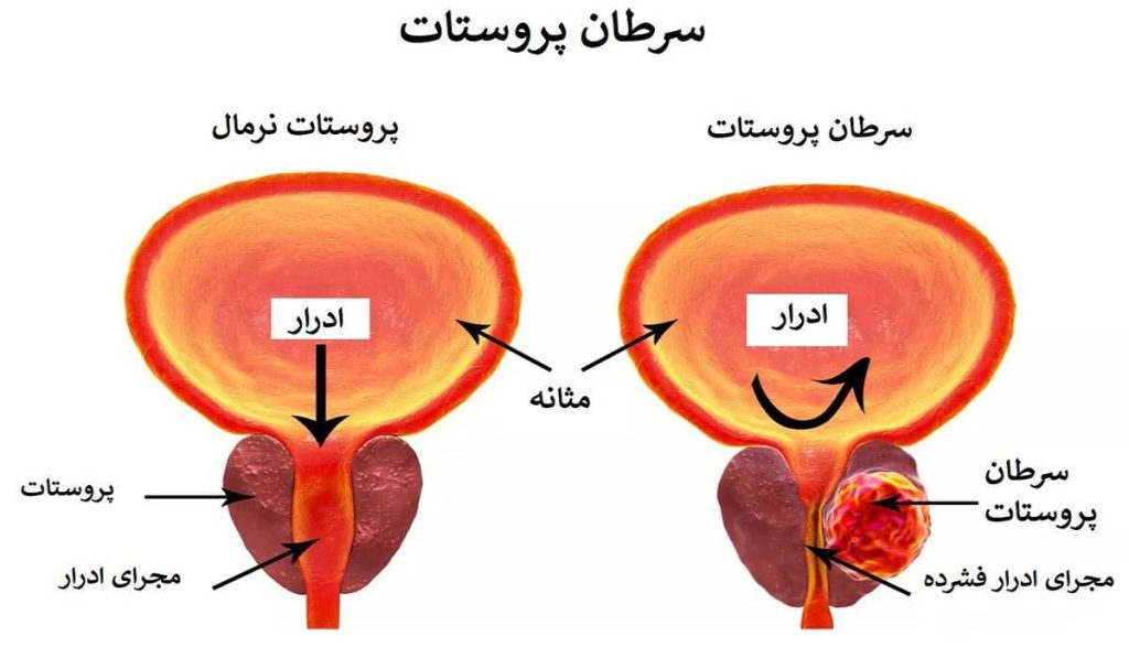 سرطان پروستات