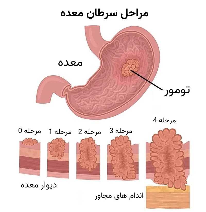 مراحل سرطان معده