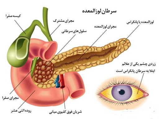 سرطان لوزالمعده