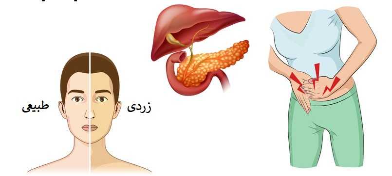 علائو سرطان لوزالمعده ( پانکراس )